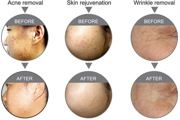 PDT 家庭用の斑点を削除するための皮膚若返り PDT 美容機を Led