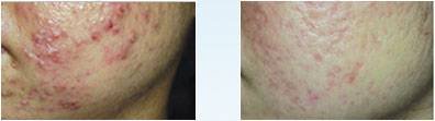 PDT 家庭用の斑点を削除するための皮膚若返り PDT 美容機を Led